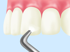 PMTC（Professional Mechanical Tooth Cleaning）