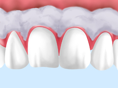ガムピーリング（歯肉のクリーニング）